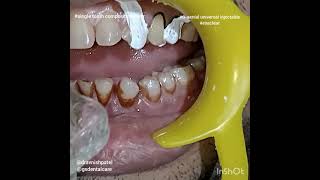 Composite Veneer  GC India  GC Gaenial Universal Injecatable technique  Exaclear  Dr Avnish [upl. by Leihcey943]