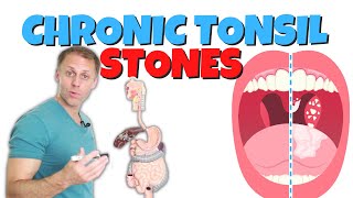 4 Steps for Chronic Tonsil Stones Tonsilloliths [upl. by Nalyad]