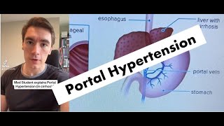 COMPLICATIONS of Portal Hypertension EXPLAINED [upl. by Annairdna942]