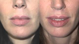 Lip Lift Surgery Before and After by Top NYC Plastic Surgeon Dr Andrew Jacono liplift [upl. by Mack]