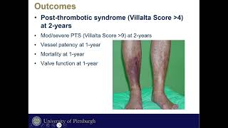 Post Thrombotic Syndrome Morbidity In Mechanical Thrombectomy Vs CDT of Iliofemoral DVT [upl. by Waers169]