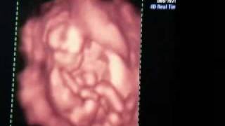 17 weeks 4d ultrasound [upl. by Alfi781]