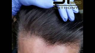 Scalp Micropigmentation for thinning hair increasing hair density [upl. by Annaiel]