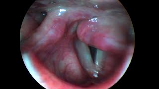 Unilateral Left Vocal Cord Paralysis [upl. by Kosel]