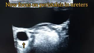 Ultrasound video of ureteric peristalsis  peristalsis in ureter [upl. by Toback]