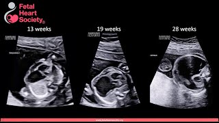 2023 ASE Fetal Echocardiography Guideline Update Progressive Fetal Cardiac Lesions [upl. by Earas]