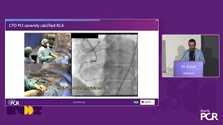 Physiology guided postDCB treatment to safely limit stenting  EuroPCR 2024 [upl. by Sherwin]