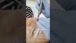 Fotona SmoothEye Treatment for Eye Bags and Skin Tightening  Upper amp Lower Eyelid Rejuvenation [upl. by Donna]