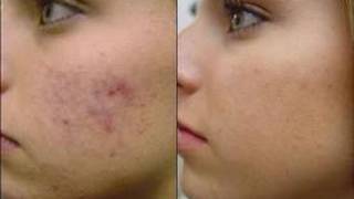 DermTV  How Do Antibiotics Treat Acne DermTVcom Epi 323 [upl. by Yrret]