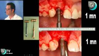 Implants Dentaires  Lexpansion osseuse par le Dr Thierry BRINCAT  GI TV [upl. by Loma]