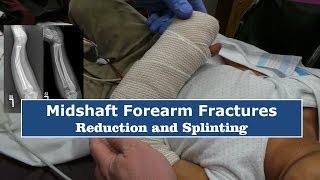 Reduction amp Splinting of Forearm FracturesQuick Version [upl. by Lennard]