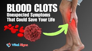 Blood Clot Warning Dangerous Symptoms of Blood Clots You Might Miss Early Signs amp Prevention Tips [upl. by Sgninnej398]