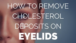 How to remove cholesterol deposits on eyelids Fast [upl. by Astto440]