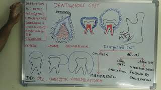 Dentigerous cyst [upl. by Fidelity426]