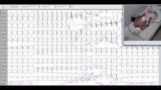 Epilepsy with myoclonic absences 1 of 2 [upl. by Birdt812]