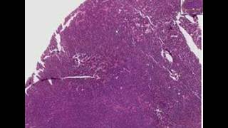 Histopathology LungSmall cell carcinoma [upl. by Kramnhoj435]