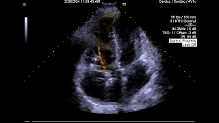 Case 4 Malfunctioning Tricuspid bioprosthesis [upl. by Ervine532]