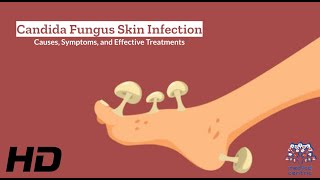 Candida Fungus Skin Infection Explained What You Need to Know [upl. by Carrelli]