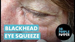 Blackhead Eye Squeeze [upl. by Nolahp]