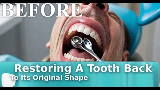 Restoring A Tooth Back To Its Original Shape  Dental Health Hub [upl. by Karlis]