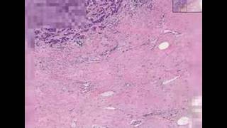 Histopathology Breast Ductal carcinoma [upl. by Opaline]