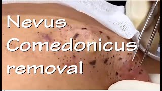 Nevus Comedonicus removal  Video 3 of 3 The ultimate quotblackheadquot removal video [upl. by Krefetz122]