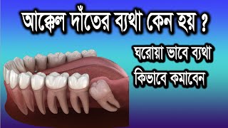 আক্কেল দাঁতের ব্যথার কারন  Wisdom Teeth Pain Relief In Bangla  Akkel Date Betha Hole Koronio [upl. by Alet782]