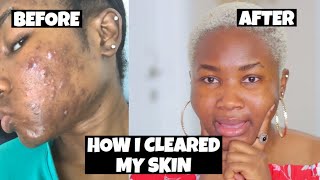 HOW I CLEARED MY SKIN  MY ACCUTANE JOURNEY BEFOREAFTER PICTURES DOSE COST ETC  OLUCHI UKAH [upl. by Rehpotsrihc]