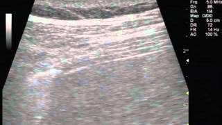 Ultrasonography of Normal and Paralyzed Diaphragms [upl. by Aidne361]