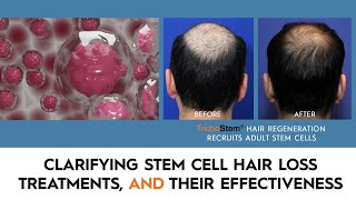 What You Need to Know About Stem Cell Hair Restoration and the Treatments that Work [upl. by Lisan898]