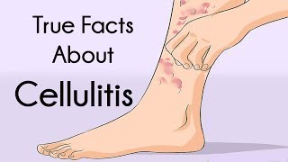 True Facts About Cellulitis [upl. by Elisa]