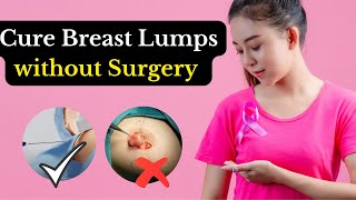 Cure Breast Lump Without Surgery  Breast Fibroadenoma  Non Surgical Treatment [upl. by Gilbert]