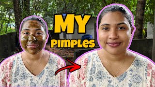 GET RID OF ACNE  pimple  dark spots  lifestyle pimples beauty [upl. by Kelula31]