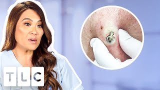 Top 5 Pimple Popping Moments From A 55YearOld Blackhead To Oozing Fistulas [upl. by Assiralk]