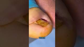 TAKE A LOOK AT THIS INGROWN TOENAIL 👀👀👀 [upl. by Nyladnewg]