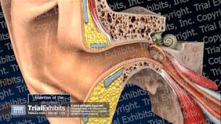 Tympanic Membrane Perforations [upl. by Arakahs]