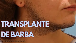 Transplante  Implante de Barba [upl. by Yramesor800]