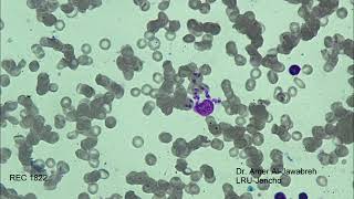 leishmania amastigotesSkin ulcer Giemsa Stain [upl. by Euphemie515]