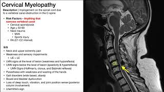 Cauda Equina Syndrome  Presentation Risk Factors amp SignsSymptoms [upl. by Hiroko]