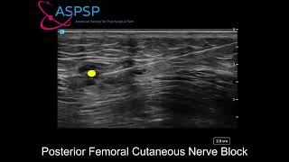 Posterior Femoral Cutaneous Nerve Block [upl. by Alek]