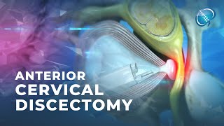 What is Endoscopic Anterior Cervical Discectomy [upl. by Lihka]