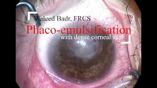 Phacoemulsification with dense corneal scar [upl. by Yoshio]