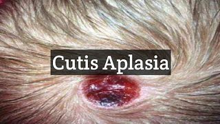 Cutis Aplasia  A skin Condition With Missing Skin Areas [upl. by Yssenhguahs815]