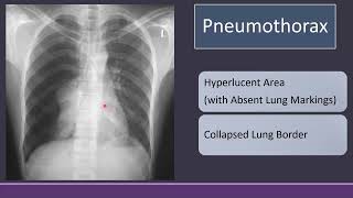 Chest Xray in Pneumothorax Typical Findings cxr radiology [upl. by Beverlee]