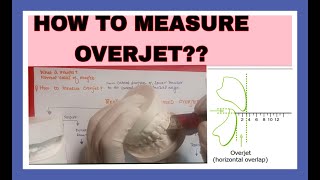 How to measure overjetproffit chapter 1 [upl. by Atilal475]