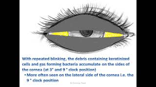 How Do ‘Bitot’s Spots’ Form [upl. by Sung]