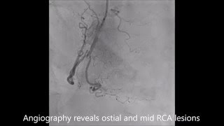 Stenting of an ostial and mid lesion of a right coronary artery [upl. by Notniw843]