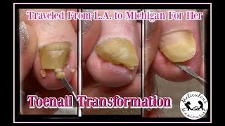 Tips to Treat Nail Fungus at Home [upl. by Arlana]