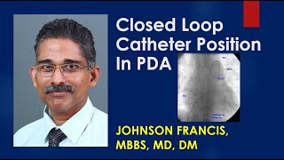 Closed Loop Catheter Position In Patent Ductus Arteriosus PDA [upl. by Demetrius]