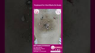 Treatment For Viral Warts On Scalp warts scalp drvimala drvimalamanne dermatologist [upl. by Thamora]